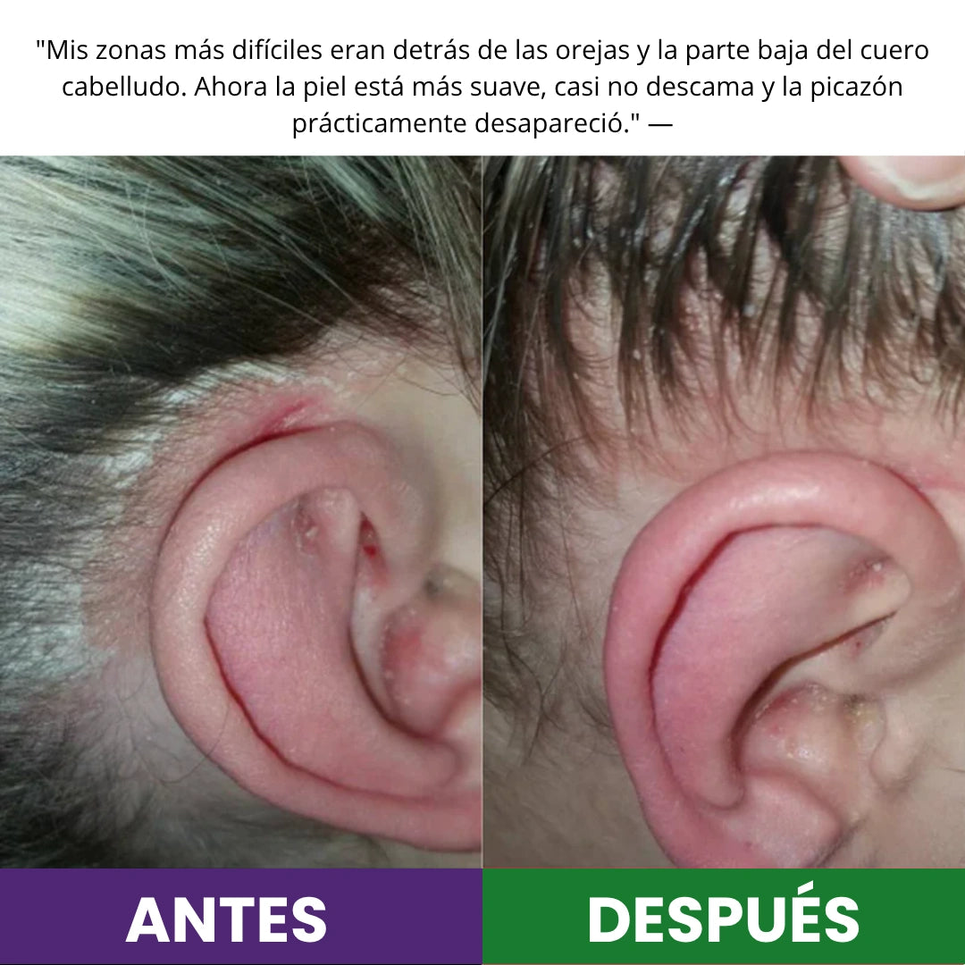 Psederol Tratamiento para La Psoriasis.